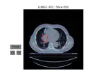 A Pipeline for Lung Tumor Detection and Segmentation from CT Scans Using Dilated Convolutional Neural Networks