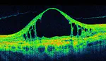 Classification of Retinal Diseases from OCT scans using Convolutional Neural Networks